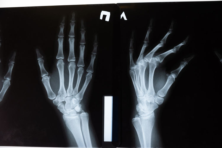 Radiografia de manos - salud osea